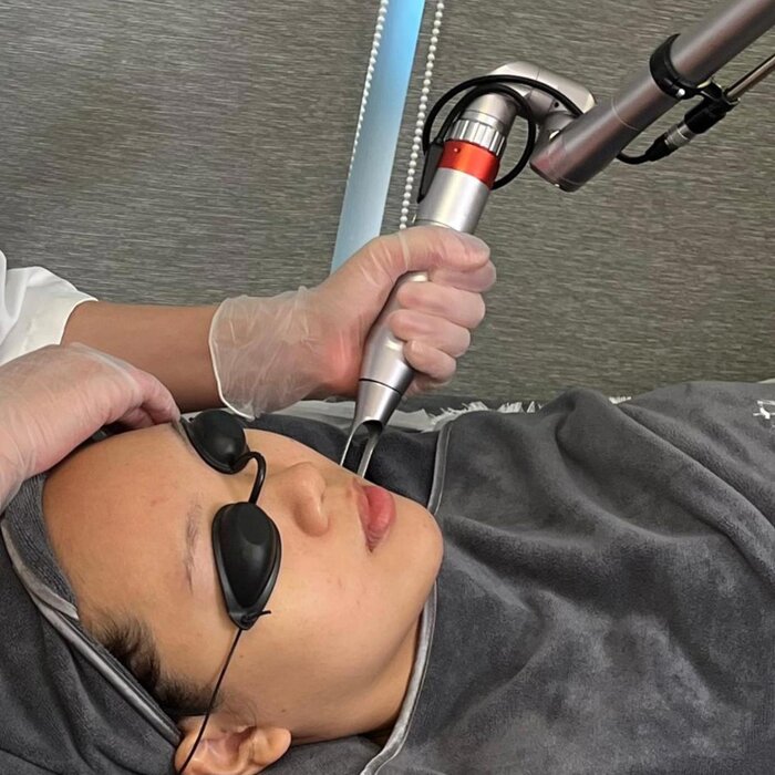 完璧な健康美 Perfect Healthy Beauty Picosecond Laser Speckle Removal Treatment Picture ColorProduct Thumbnail